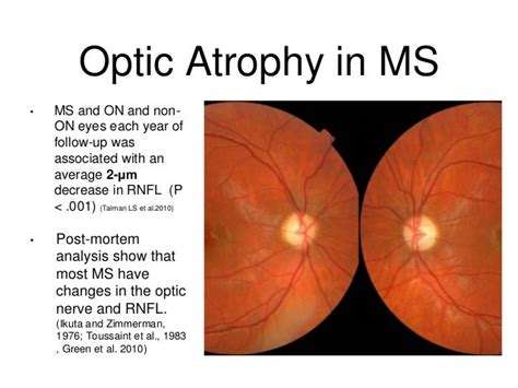 Is optic neuritis always MS?