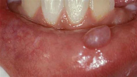 Is oral mucocele hard or soft?