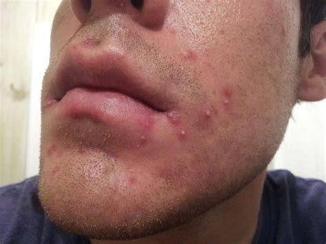 Is painful acne normal?