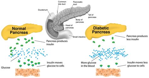 Is pancreatitis like diabetes?