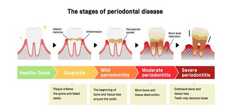 Is periodontitis lifelong?
