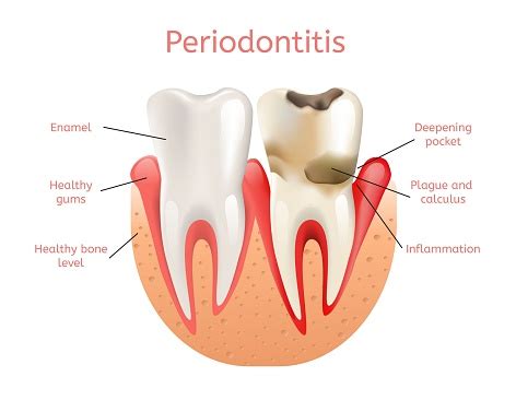 Is periodontitis self treatable?