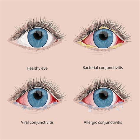 Is pink eye harmless?