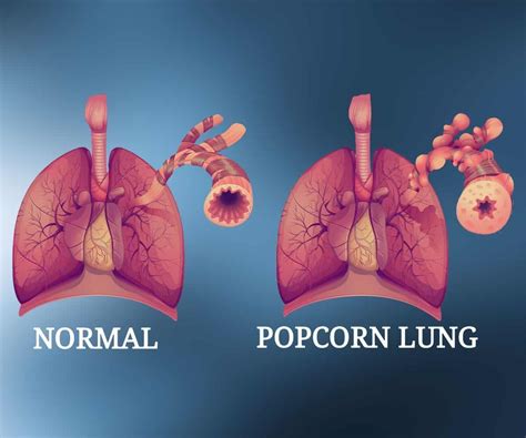 Is popcorn lung curable?