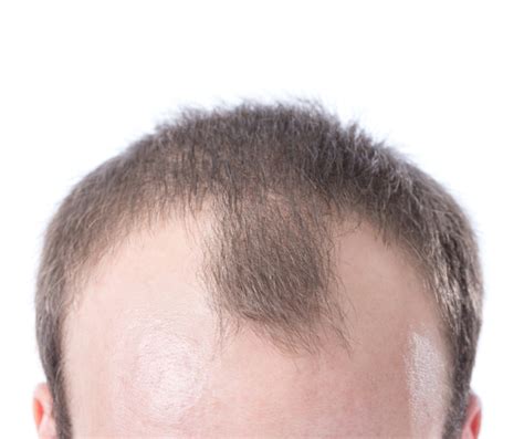 Is receding hairline at 21 normal?