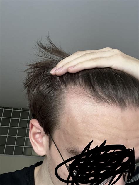 Is receding hairline normal at 18?