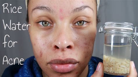 Is rice water good for acne?