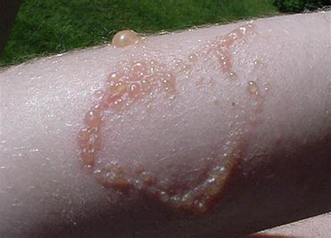 Is running hot water over poison ivy bad?