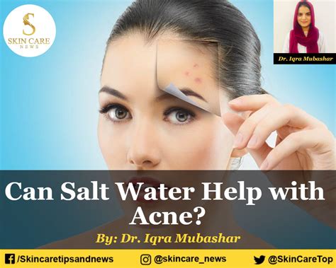 Is salt water good for acne?