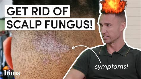 Is scalp fungus curable?