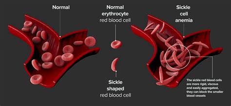 Is sickle cell anemia for life?
