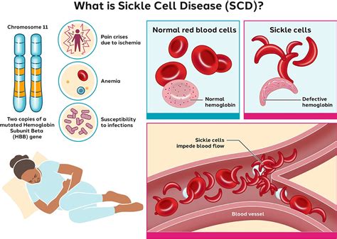 Is sickle cell anemia forever?