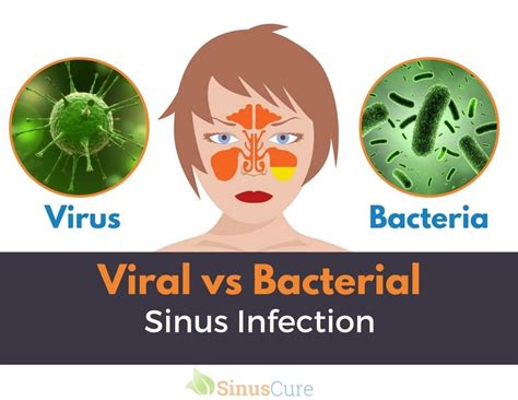 Is sinusitis bacterial or viral?