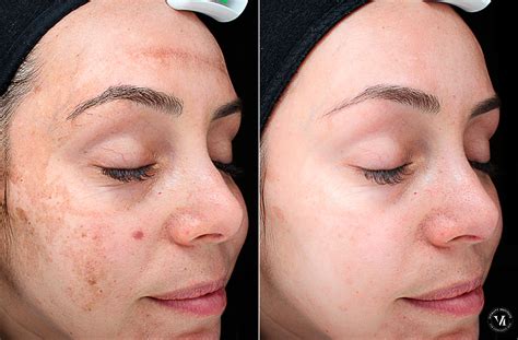 Is skin peeling normal after skin care?