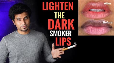 Is smokers lips permanent?