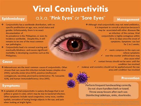 Is sore eyes a virus?