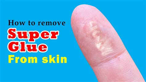 Is super glue bad for your skin?