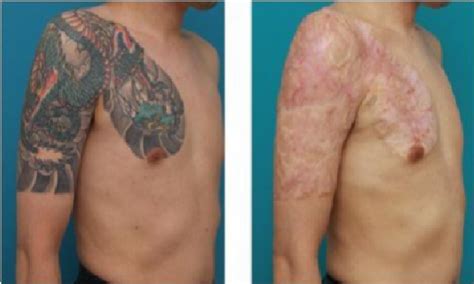 Is tattoo removal easier now?
