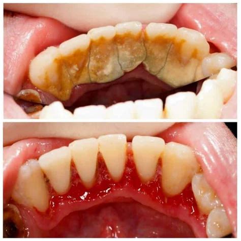 Is teeth washing painful?