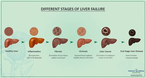 Is there a smell to liver failure?