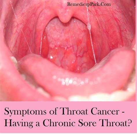 Is there a stage 5 throat cancer?