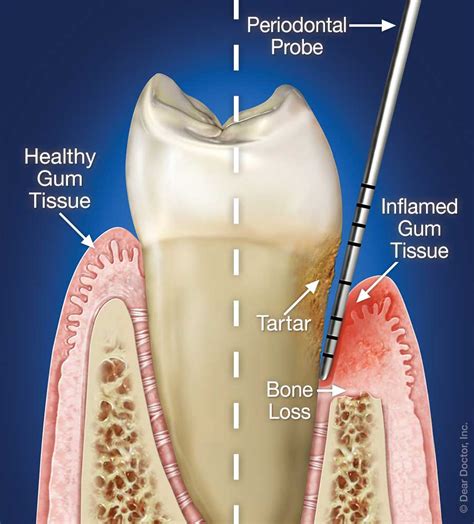 Is there hope for periodontitis?