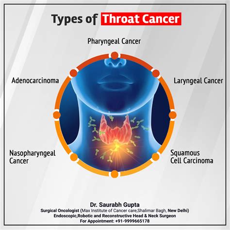 Is throat cancer genetic?