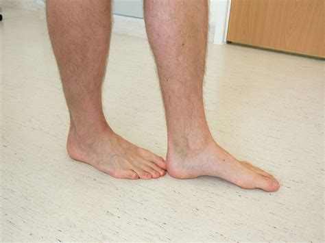 Is toe walking damaging?