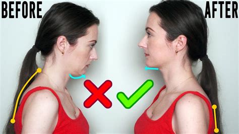 Is tongue posture real?