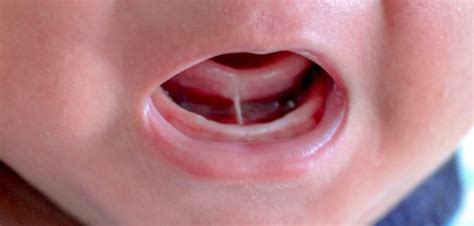 Is tongue tie linked to ADHD?