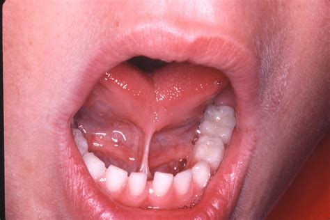 Is tongue tie overdiagnosed?