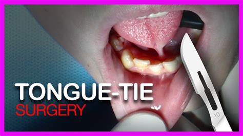 Is tongue-tie surgery worth it?