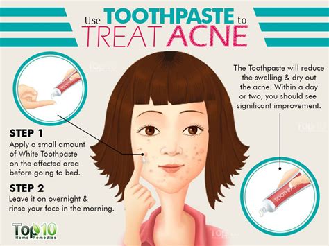 Is toothpaste good for acne?