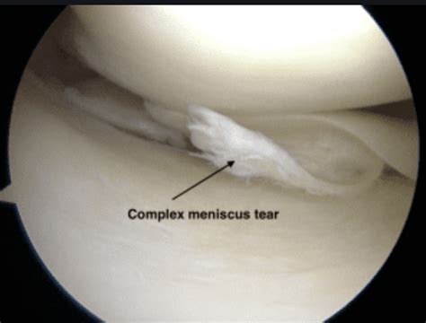 Is torn cartilage permanent?
