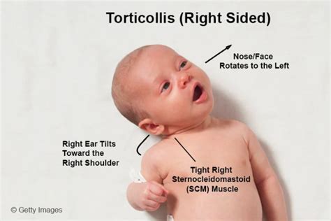 Is torticollis serious?