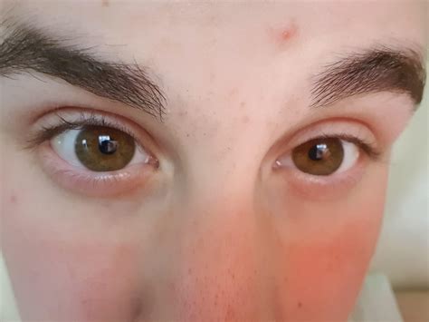 Is upper eyelid exposure unattractive?