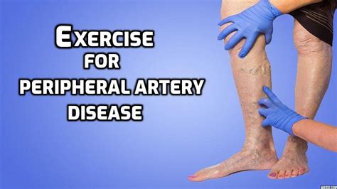 Is walking good for blocked arteries in the legs?
