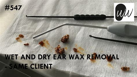Is wet earwax better?