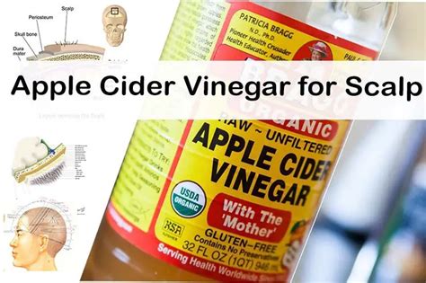Is white vinegar safe for scalp?