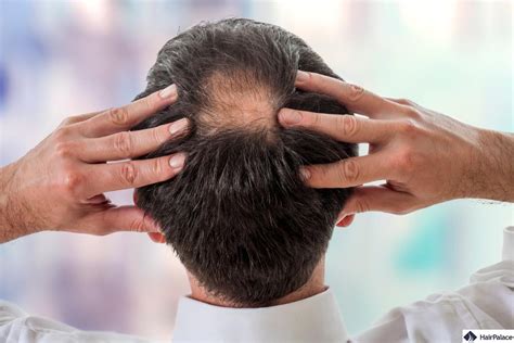 Should I be worried if I have a bald spot?