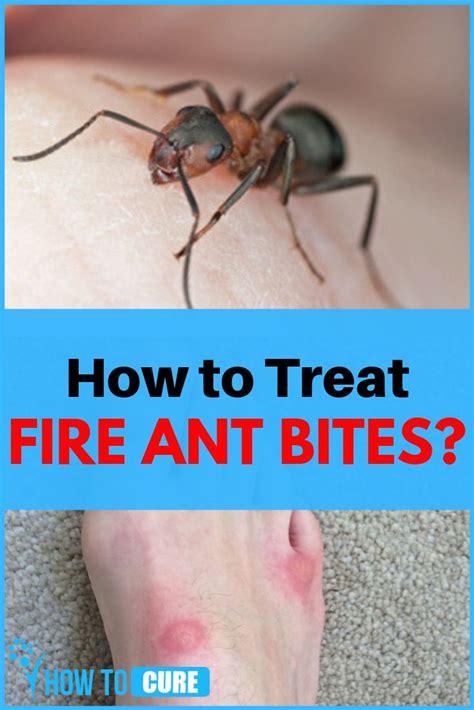 Should I be worried if an ant bites me?