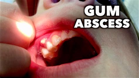 Should I brush a gum abscess?