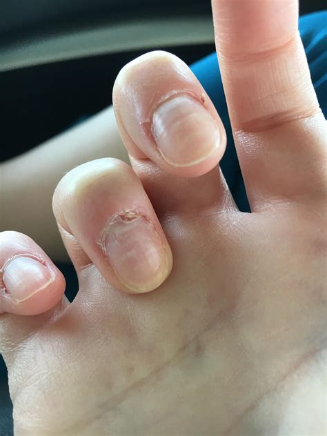 Should I cover an exposed nail bed?