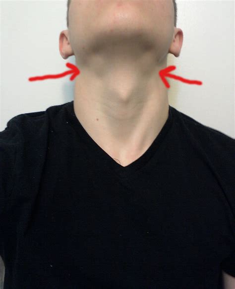 Should I feel a lump under my jaw?