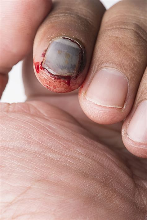 Should I get worried about injury from a nail?