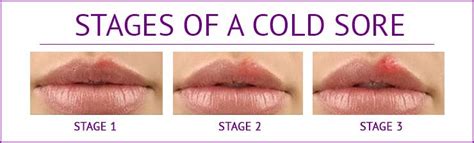Should I mess with a cold sore?