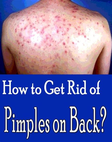 Should I moisturize my back if I have back acne?