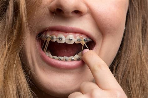 Should I open my mouth with elastics?