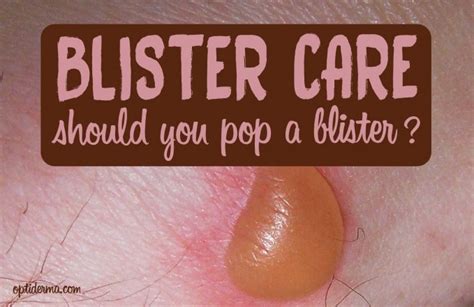 Should I pop a white burn blister?