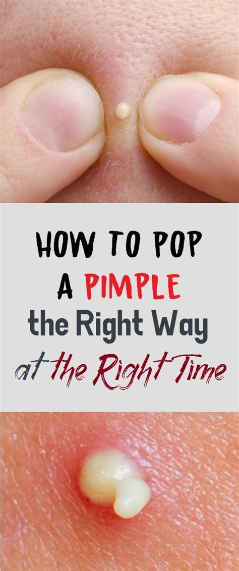 Should I pop pimple with white head?